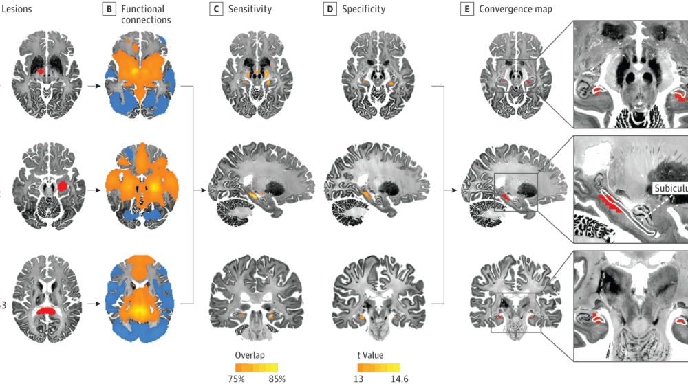 Lesions and their shared connections in the psychosis study.